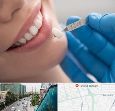مرکز لمینت دندان در بلوار فرحزادی