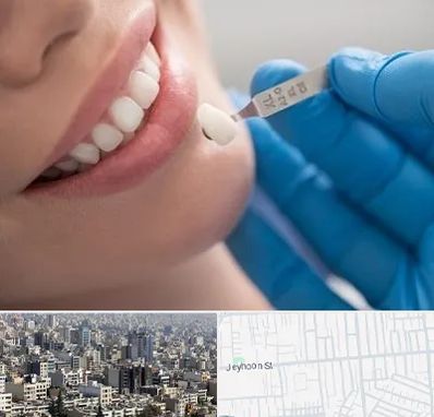 مرکز لمینت دندان در جیحون