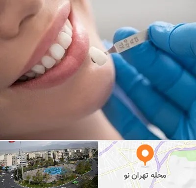 مرکز لمینت دندان در تهران نو