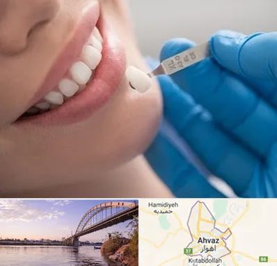مرکز لمینت دندان در اهواز