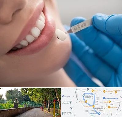 مرکز لمینت دندان در فلکه گاز رشت