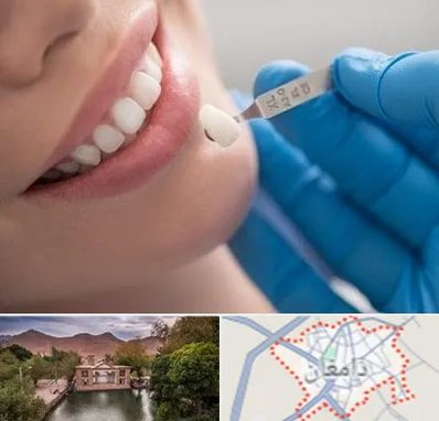 مرکز لمینت دندان در دامغان