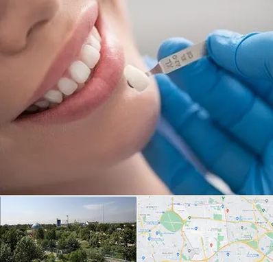 مرکز لمینت دندان در منطقه 16 تهران