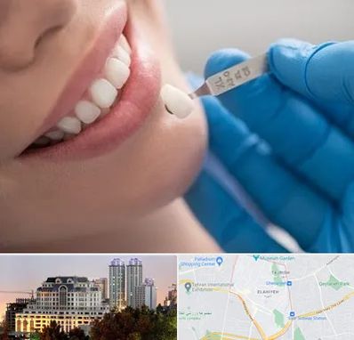 مرکز لمینت دندان در فرشته