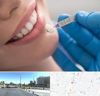 مرکز لمینت دندان در بلوار کلاهدوز مشهد