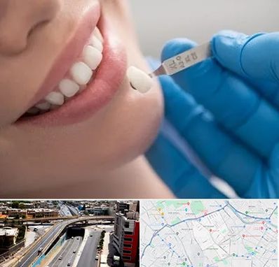 مرکز لمینت دندان در ستارخان شیراز