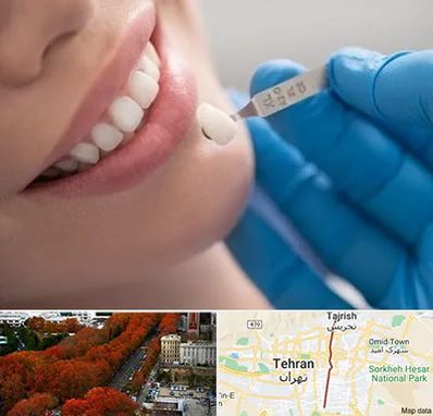 مرکز لمینت دندان در ولیعصر