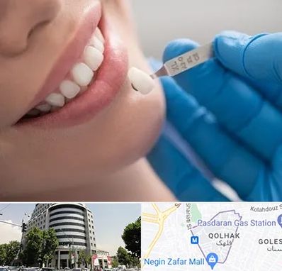 مرکز لمینت دندان در قلهک