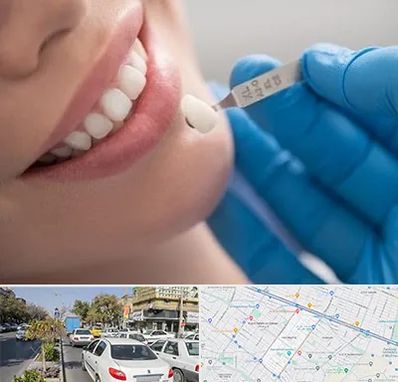 مرکز لمینت دندان در مفتح مشهد