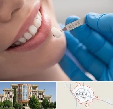 مرکز لمینت دندان در دهدشت