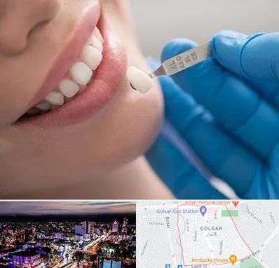 مرکز لمینت دندان در گلسار رشت