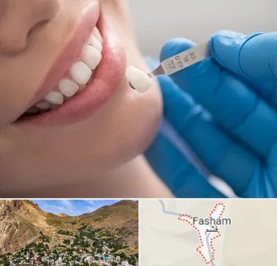 مرکز لمینت دندان در فشم
