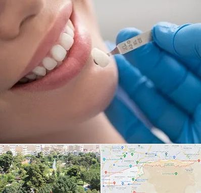 مرکز لمینت دندان در منطقه 13 تهران