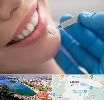 مرکز لمینت دندان در لاهیجان
