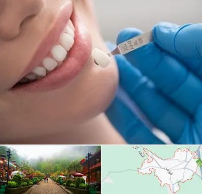 مرکز لمینت دندان در فومن