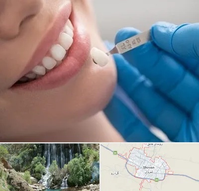 مرکز لمینت دندان در شیروان