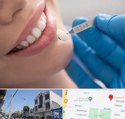 مرکز لمینت دندان در افسریه