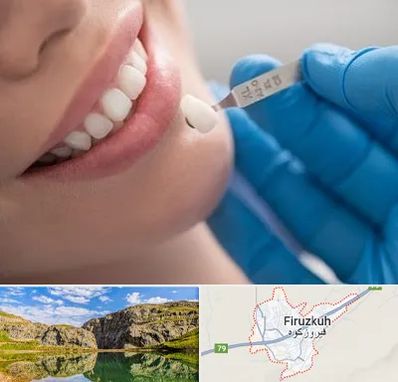مرکز لمینت دندان در فیروزکوه