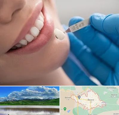 مرکز لمینت دندان در مرند