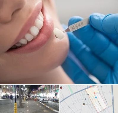 مرکز لمینت دندان در باغ فیض اسلامشهر