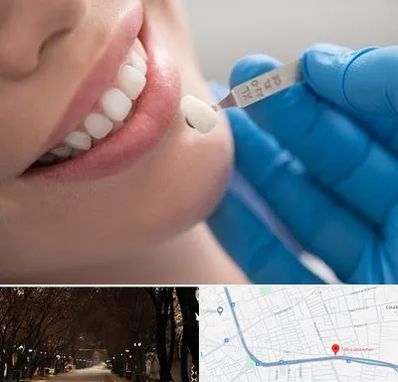 مرکز لمینت دندان در ابوریحان تبریز