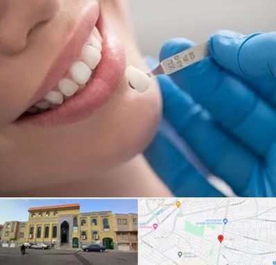 مرکز لمینت دندان در زنبیل آباد قم