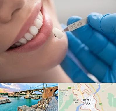 مرکز لمینت دندان در دزفول