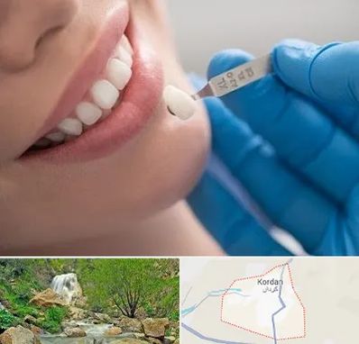 مرکز لمینت دندان در کردان