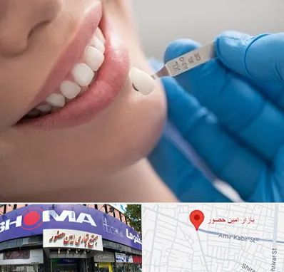 مرکز لمینت دندان در امین حضور