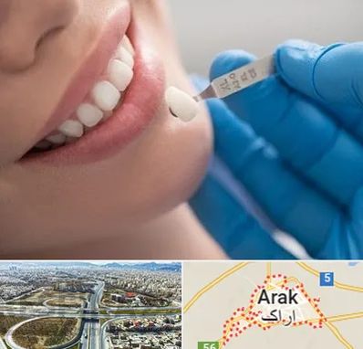 مرکز لمینت دندان در اراک