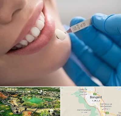 مرکز لمینت دندان در بروجرد