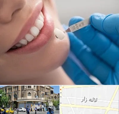 مرکز لمینت دندان در لاله زار