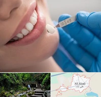 مرکز لمینت دندان در علی آباد کتول