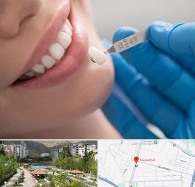 مرکز لمینت دندان در بلوار تعاون