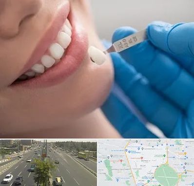 مرکز لمینت دندان در منطقه 17 تهران