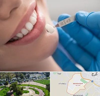 مرکز لمینت دندان در مهرشهر کرج
