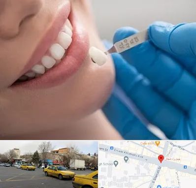 مرکز لمینت دندان در شهناز تبریز