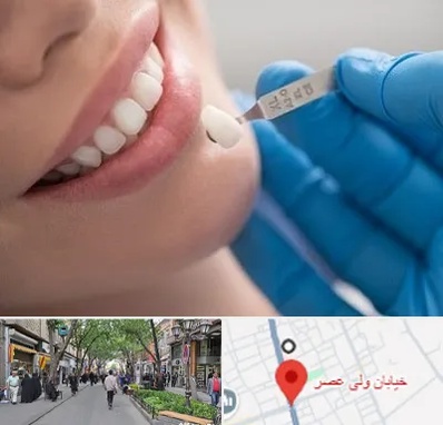 مرکز لمینت دندان در ولیعصر شهریار