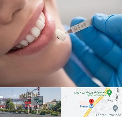 مرکز لمینت دندان در هروی