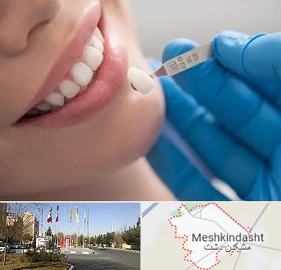 مرکز لمینت دندان در مشکین دشت