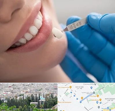 مرکز لمینت دندان در محلاتی شیراز