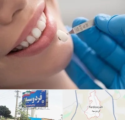 مرکز لمینت دندان در فردوسیه شهریار