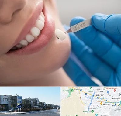 مرکز لمینت دندان در شریعتی مشهد