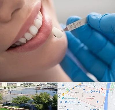 مرکز لمینت دندان در گلستان اهواز