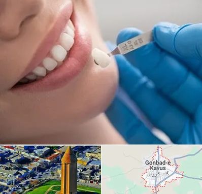 مرکز لمینت دندان در گنبد کاووس