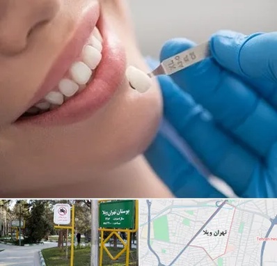 مرکز لمینت دندان در تهران ویلا