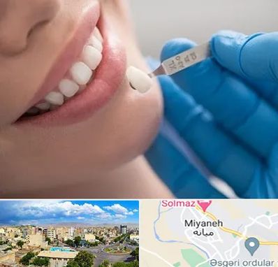 مرکز لمینت دندان در میانه