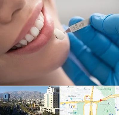 مرکز لمینت دندان در حقانی