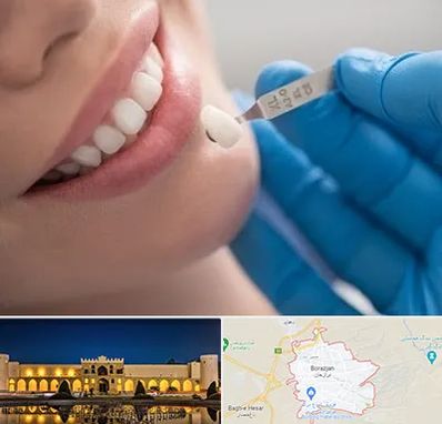 مرکز لمینت دندان در برازجان
