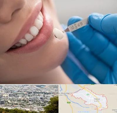 مرکز لمینت دندان در یاسوج